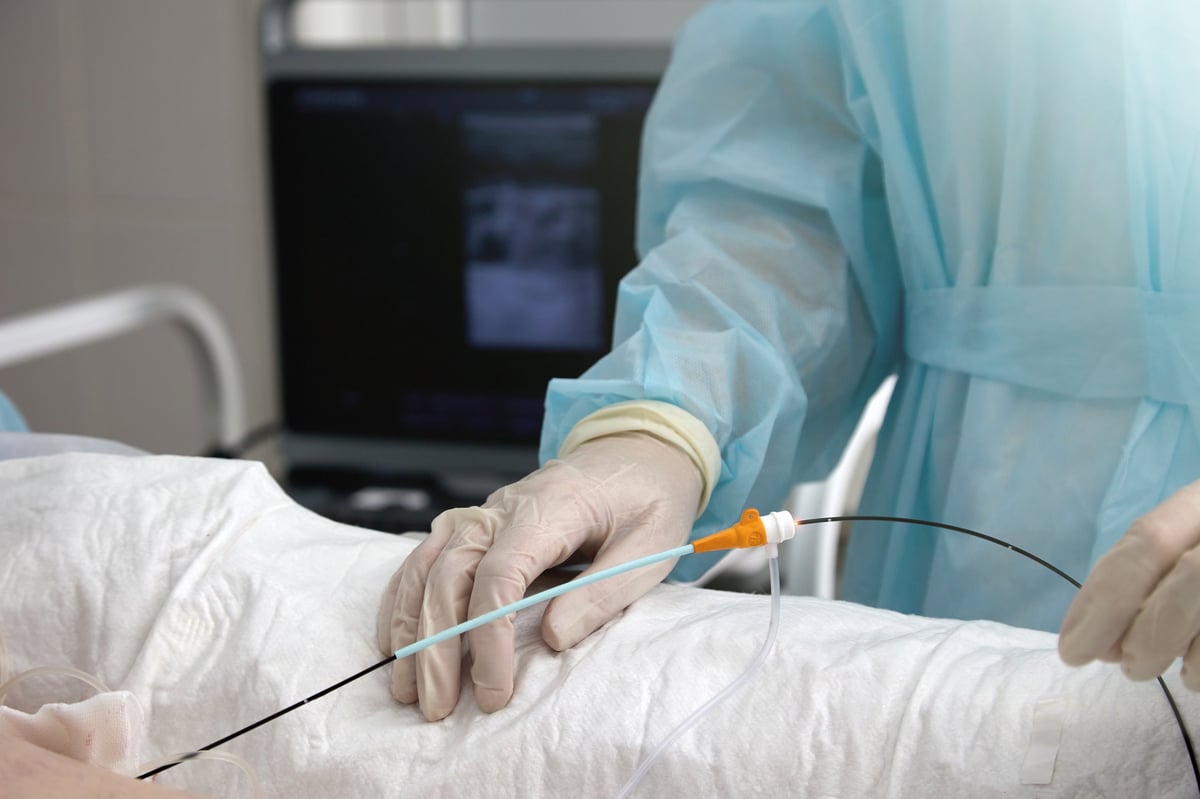 Vascular surgeon inserts catheter into vein treat varicose veins