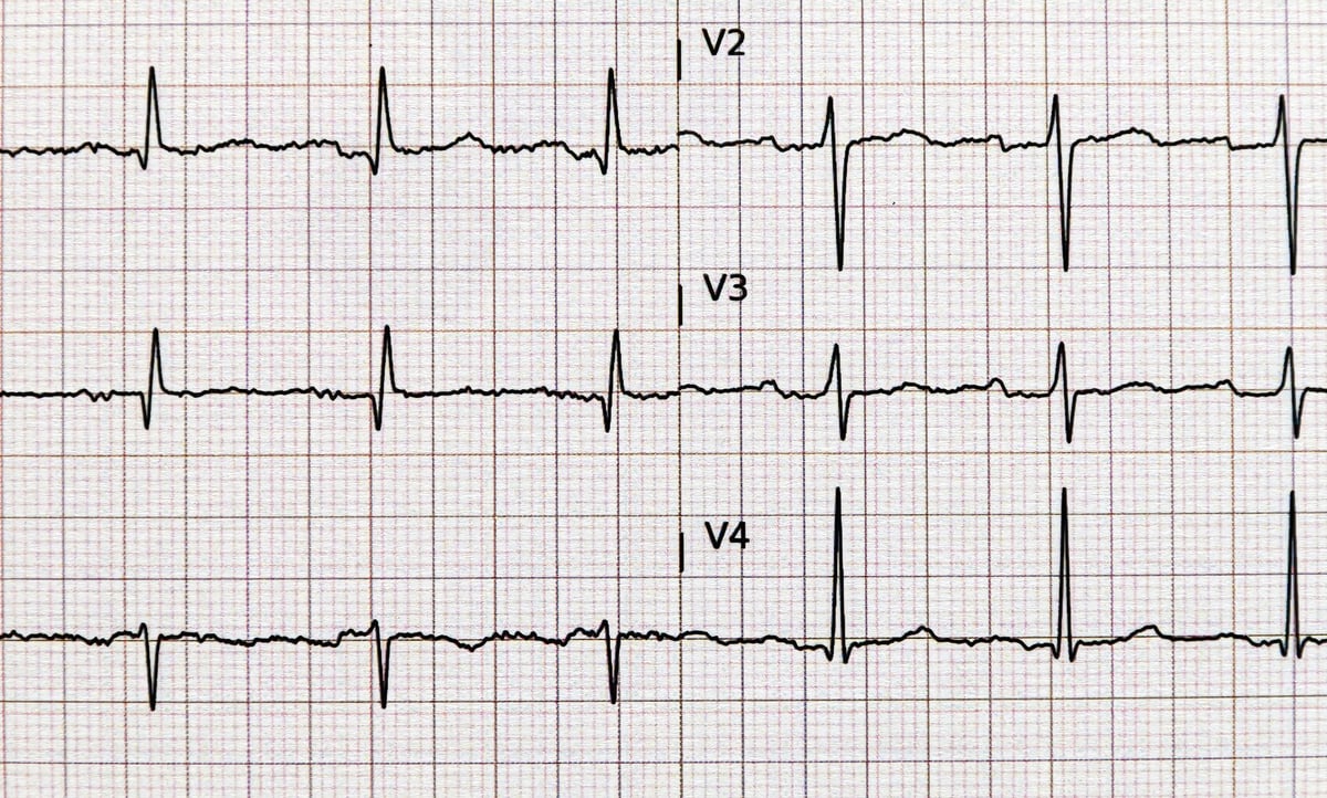 Trazado de electrocardiograma